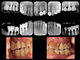 東京でインプラントの名医の治療例の15年後