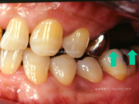 東京大手町の歯科で行なったインプラント症例の治療前