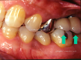 東京大手町の歯科で行なったインプラント症例の治療後