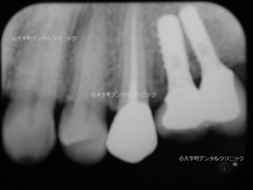 東京大手町の歯科で行なったインプラント症例の治療後のレントゲン