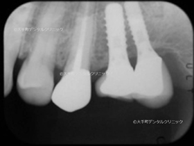 東京大手町の歯科で行なったインプラント症例の25年後のレントゲン
