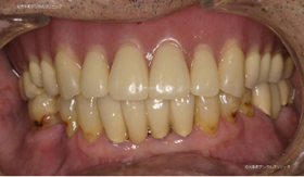 東京丸の内の歯科でおこなったインプラントの治療例上顎（治療前）