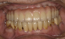 東京丸の内の歯科でおこなったインプラントの治療例上顎（治療後）