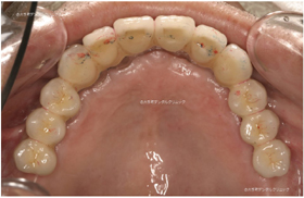 東京のインプラント専門医の治療例上顎（治療後）