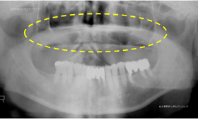 東京のインプラント専門医の治療例レントゲン