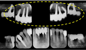 東京のインプラント専門医の治療後のレントゲン