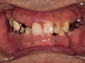 丸の内の歯科№1のインプラント治療例（治療前）