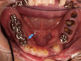 丸の内の歯医者№1のインプラント治療例（治療前）
