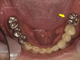 丸の内の歯医者№1のインプラント治療例（治療後）