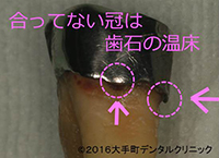 歯周病と冠の関係の写真