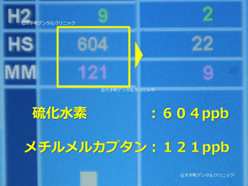 東京で口臭の専門治療した時の治療前のデータ