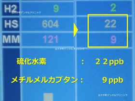 東京で口臭の専門治療した時の治療後のデータ