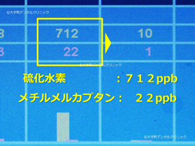 口臭治療をして口臭がなくなった例の治療前