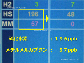 口臭治療前のデータ