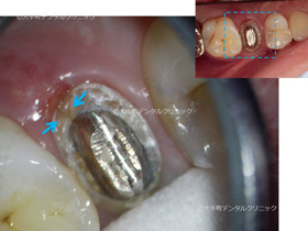 歯の根が割れている状態02