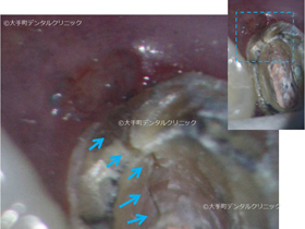 東京で根管治療おすすめの歯科の治療02