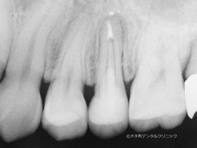 東京で根管治療の名医の治療後のレントゲン像