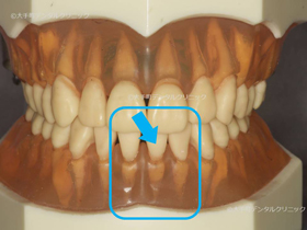 治療した下の前歯の場所