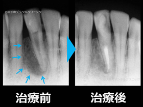 東京で歯の根の治療おすすめの歯科の治療例