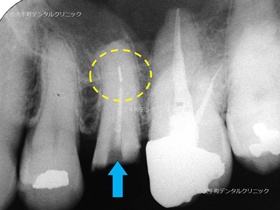 根管治療で破折した治療器具を取り除く前のレントゲン