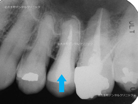 根管治療で破折した治療器具を取り除いた後のレントゲン
