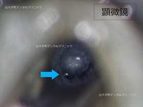 東京でおすすめの名医が歯科用顕微鏡で折れた治療器具を確認