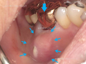 大きく腫れ膿が出ている下の奥歯