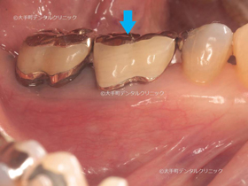 腫れが無くなり良くなった下の奥歯