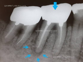 東京の歯の根の治療専門医の根の治療前のレントゲン