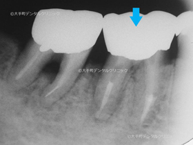 東京で根管治療専門医の治療後のレントゲン