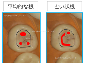 平均的な根管口ととい（樋）状根の根管口の違い