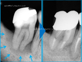 東京の根管治療の専門医の治療前と治療後の比較