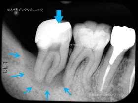 東京で根管治療が上手い歯医者の治療例の治療前