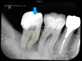 東京で根管治療の名医の治療前のレントゲン