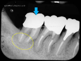 東京で根管治療の名医の治療後のレントゲン