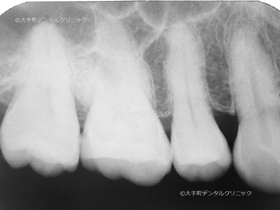 歯内療法専門医の治療前のレントゲン 
