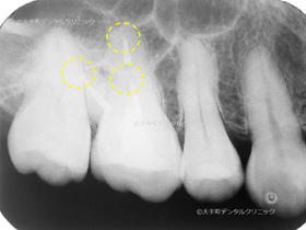 歯内療法専門医の治療後のレントゲン