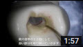 東京で顕微鏡を使って歯の根の治療をする歯医者（歯科）