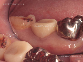 東京の歯の根の治療の名医が行った後の歯の画像