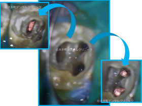 東京の歯の根の治療の名医が行った根管充填時の画像