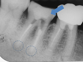 東京の歯の根の治療の名医が行った治療後のレントゲン画像