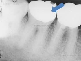 下の奥歯の治療前のレントゲン画像