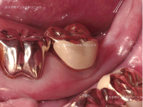 東京大手町の歯科の名医の根の治療例術後