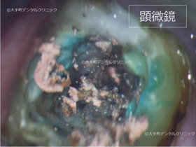 東京で根の治療おすすめの歯医者の治療例
