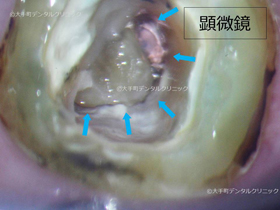 根管拡大前の樋状根の根管口