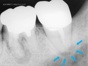 東京でおすすめの歯医者の根管治療前のレントゲン