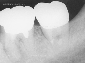 東京で有名な歯医者の歯の根の治療後のレントゲン