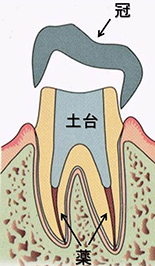 東京で根管治療（歯内療法）の名医