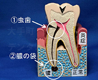 歯の痛みの原因