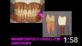 東京で歯の根の治療（根管治療、神経の治療）の名医